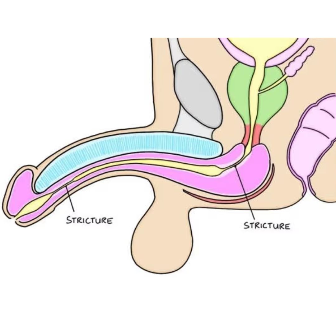 Medical illustration showing urethral stricture locations along the male urethra
